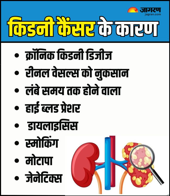 Kidney Cancer